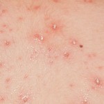 Penderita cacar monyet-1653804269